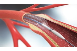 balloon catheter graphic