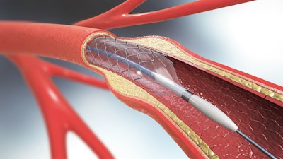 balloon catheter graphic