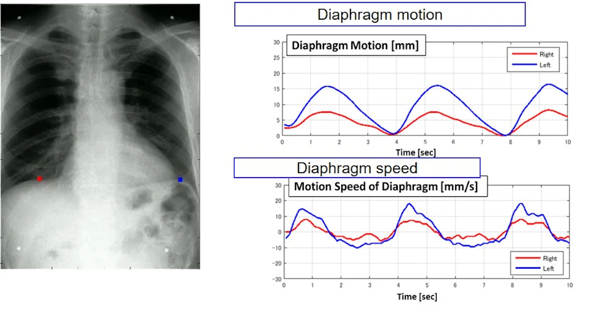 Am Radiographic University of Alabama at Birmingham reaches 1,000 patient pulmonary ...