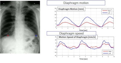 Dynamic digital radiography is an enhanced X-ray technology that enables clinicians to analyze and quantify the dynamic interaction of anatomical structures with physiological changes over time to enhance diagnostic capability and efficacy.