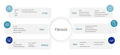 Fibrosis Model