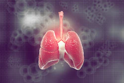 Graphic showing a pair of human lungs