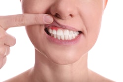 Person holding lip up to show gum disease in mouth.