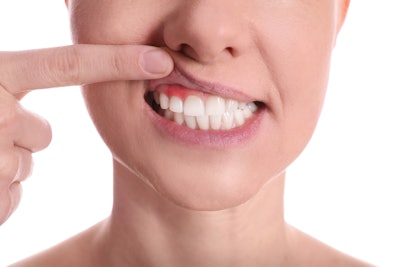 Person holding lip up to show gum disease in mouth.