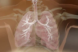 Photo displays x-ray image of damaged, inflammed lung.