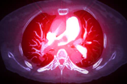 A CTA pulmonary artery reveals a detailed view of the lung blood vessels, capturing the presence of a pulmonary embolism.
