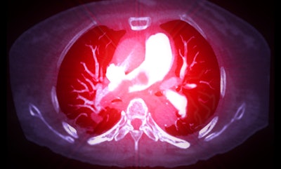 A CTA pulmonary artery reveals a detailed view of the lung blood vessels, capturing the presence of a pulmonary embolism.