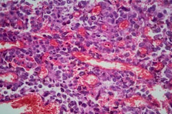 Magnified sample of lung tissue displaying adenocarcinoma (cancer).