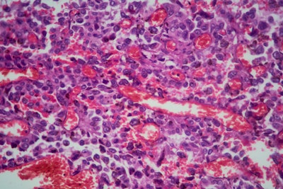 Magnified sample of lung tissue displaying adenocarcinoma (cancer).