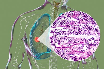 A human body with transparent skin showcasing lung cancer, 3D illustration complemented by a light micrograph of the small cell lung cancer.