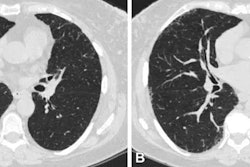 Axial chest CT scans at (A) visit 1 and (B) visit 2 at the level of the takeoff of the right middle bronchus of a participant with 1.2 annual percentage quantitative interstitial abnormality progression.