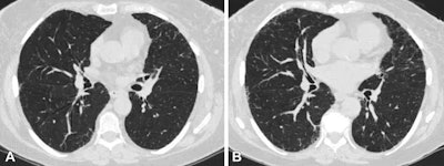 Axial chest CT scans at (A) visit 1 and (B) visit 2 at the level of the takeoff of the right middle bronchus of a participant with 1.2 annual percentage quantitative interstitial abnormality progression.