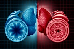 This photo illustrates a diagram of a good lung and an inflamed lung;