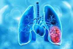 Cancer growth in human respiratory system, 3d illustration.