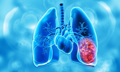 Cancer growth in human respiratory system, 3d illustration.