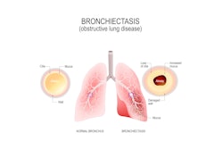 Illustrated comparison of normal bronchus and bronchiectasis.