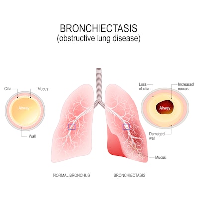 Illustrated comparison of normal bronchus and bronchiectasis.