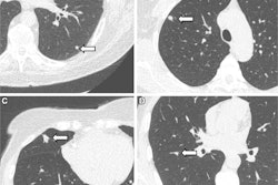 Representative chest low-dose CT images show lung nodules (arrows) and were included in the study. (A) A solid lung nodule, 82 mm3, in a 77-year-old male participant. (B) A clinically relevant nodule, 174 mm3, in a 55-year-old female participant. (C) An actionable nodule, 422 mm3, in a 79-year-old female participant. (D) A typical perifissural nodule, 183 mm3, in a 46-year-old male participant.