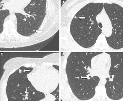 Representative chest low-dose CT images show lung nodules (arrows) and were included in the study. (A) A solid lung nodule, 82 mm3, in a 77-year-old male participant. (B) A clinically relevant nodule, 174 mm3, in a 55-year-old female participant. (C) An actionable nodule, 422 mm3, in a 79-year-old female participant. (D) A typical perifissural nodule, 183 mm3, in a 46-year-old male participant.