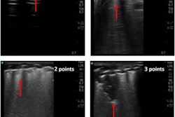 Lung ultrasound imaging related to LUS score (0–3). Score 0: normal A-lines with a continuous and regular pleural line. Score 1: multiple separated B-lines. Score 2: coalescent B-lines pattern with alterations of the pleural line. Score 3: consolidation area and possibly a large white lung artifact.