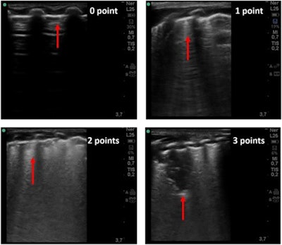 Lung ultrasound imaging related to LUS score (0–3). Score 0: normal A-lines with a continuous and regular pleural line. Score 1: multiple separated B-lines. Score 2: coalescent B-lines pattern with alterations of the pleural line. Score 3: consolidation area and possibly a large white lung artifact.