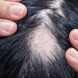 This is a photo of male hair loss.