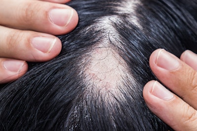 This is a photo of male hair loss.