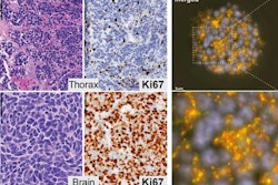 atypical small cell lung cancer