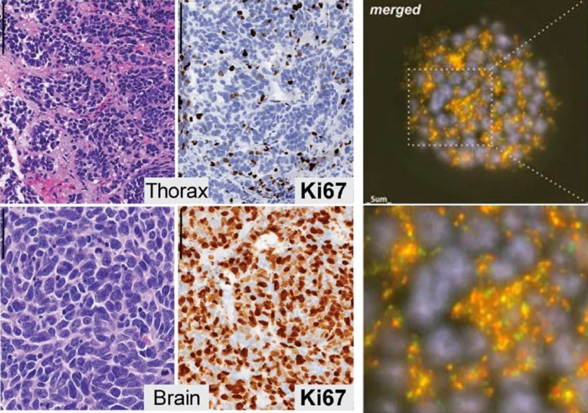 Rare lung cancer subtype identified Pulmonary