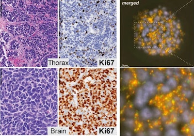 atypical small cell lung cancer