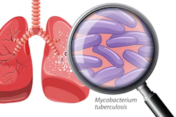 Human Lung with Tuberculosis illustration
