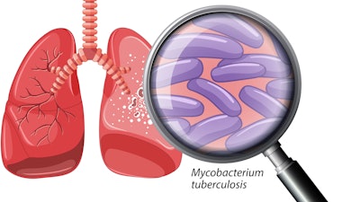 Human Lung with Tuberculosis illustration