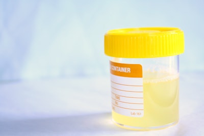 This is a photo of a urine sample in a lab bottle.