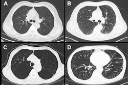 Representative high-resolution CT images of COPD. (A) COPD without emphysema or ILA, (B) COPD with ILA but not emphysema, (C) COPD with emphysema but not ILA, (D) COPD with emphysema and ILA.