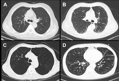 Representative high-resolution CT images of COPD. (A) COPD without emphysema or ILA, (B) COPD with ILA but not emphysema, (C) COPD with emphysema but not ILA, (D) COPD with emphysema and ILA.