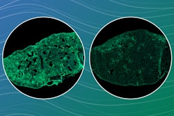 Lung fibrosis occurs after accumulation of scar tissue in the lung. A mouse lung with scarring tissue (left image) was reduced after treatment with dextromethorphan (right image).