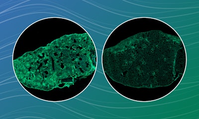 Lung fibrosis occurs after accumulation of scar tissue in the lung. A mouse lung with scarring tissue (left image) was reduced after treatment with dextromethorphan (right image).