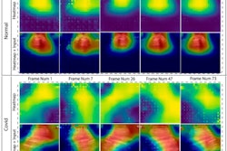 Heatmaps the AI assessed to make lung disease diagnoses.