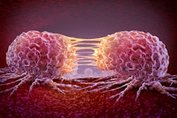 Malignant Cancerous Growth as growing dividing tumor cells and Malignancy disease spreading metastasized on an organ inside the human body as a 3D illustration.