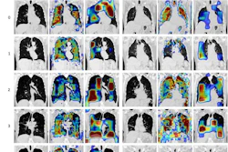 Image of lung scans from COPD patients as part of a study.