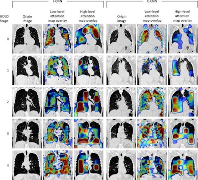 Image of lung scans from COPD patients as part of a study.