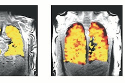 Lung function MRI showing problem areas (measurement levels of dysfunction) in lung transplant recipients.