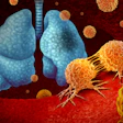 Depiction of lung cancer caused by a tumor