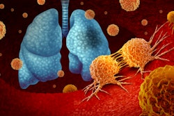 Depiction of lung cancer caused by a tumor