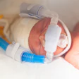Premature baby on a ventilator in the Neonatal Intensive Care Unit
