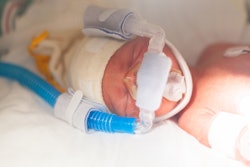 Premature baby on a ventilator in the Neonatal Intensive Care Unit
