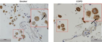 Alveolar macrophages under the microscope showing deposits of black carbon. Left - smaller deposits in cells from a smoker, Right - larger deposits in cells from COPD patient.