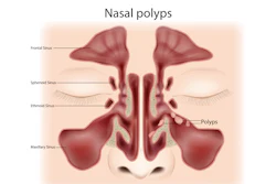 Nasal Polyps Enewslettercrop