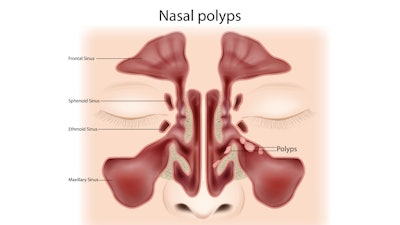 Nasal Polyps Enewslettercrop