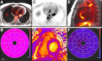 Figure 3. Periannular uptake. Representative examples show hybrid, fused PET/MRI in patients with findings suggestive of periannular uptake. (A) Axial view with uptake in basal lateral and basal septal regions, surrounding mitral annulus. (B) T2 values are globally increased, especially in basal septum. (C) Axial view with increased 18F-FDG uptake in regions surrounding mitral annulus. (D) T1 values are increased in basal septum. (E) Sagittal view with increased uptake in basal segments surrounding mitral valve annulus. (F) ECV values are increased, especially in basal to mid-septum. SUV scale is 0–5 g/mL. AHA = American Heart Association; ECV = extracellular volume.